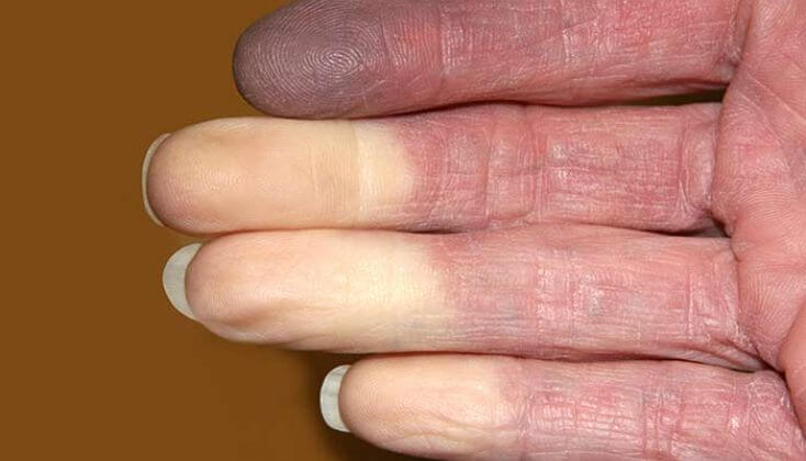 Vibration White Finger Payout Guide: What Workers Need to Know